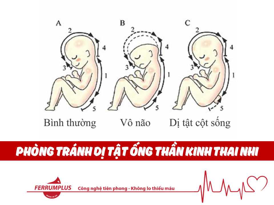 Dị tật ống thần kinh thai nhi -  mẹ nhất định phải tìm hiểu để không “làm khổ con”