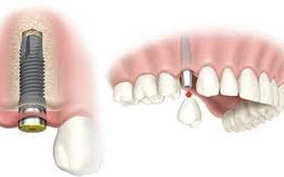 Cấy răng bằng implant