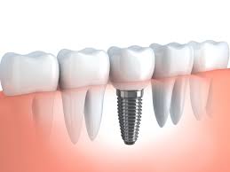 Giới thiệu về điều trị cấy ghép implant nha khoa