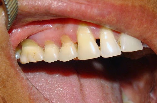 Phòng và điều trị mòn răng