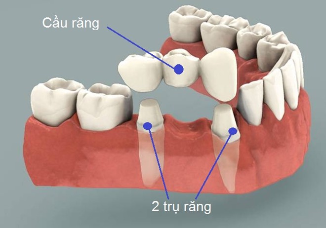 Cách làm cầu răng