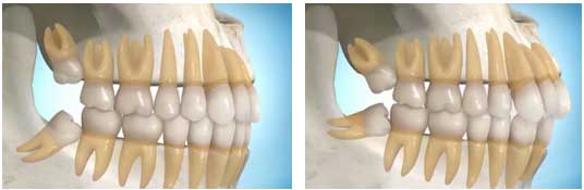 Rắc rối bởi răng khôn mọc 'dại'