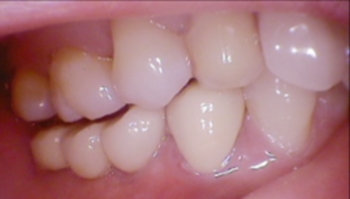 Cấy chuyển răng – kỹ thuật cao