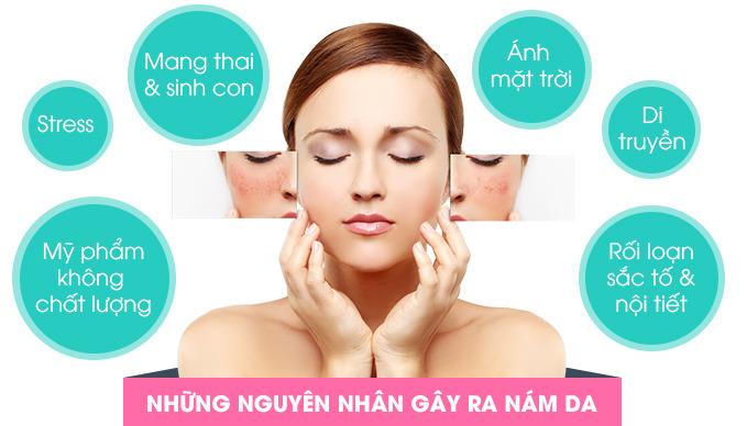 Nguyên nhân gây nám và tàn nhang