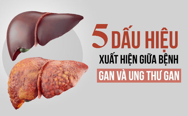 5 dấu hiệu cảnh báo ung thư gan và cách phòng bệnh hiệu quả