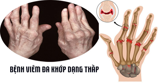 Bài thuốc chữa viêm đa khớp dạng thấp an toàn hiệu quả