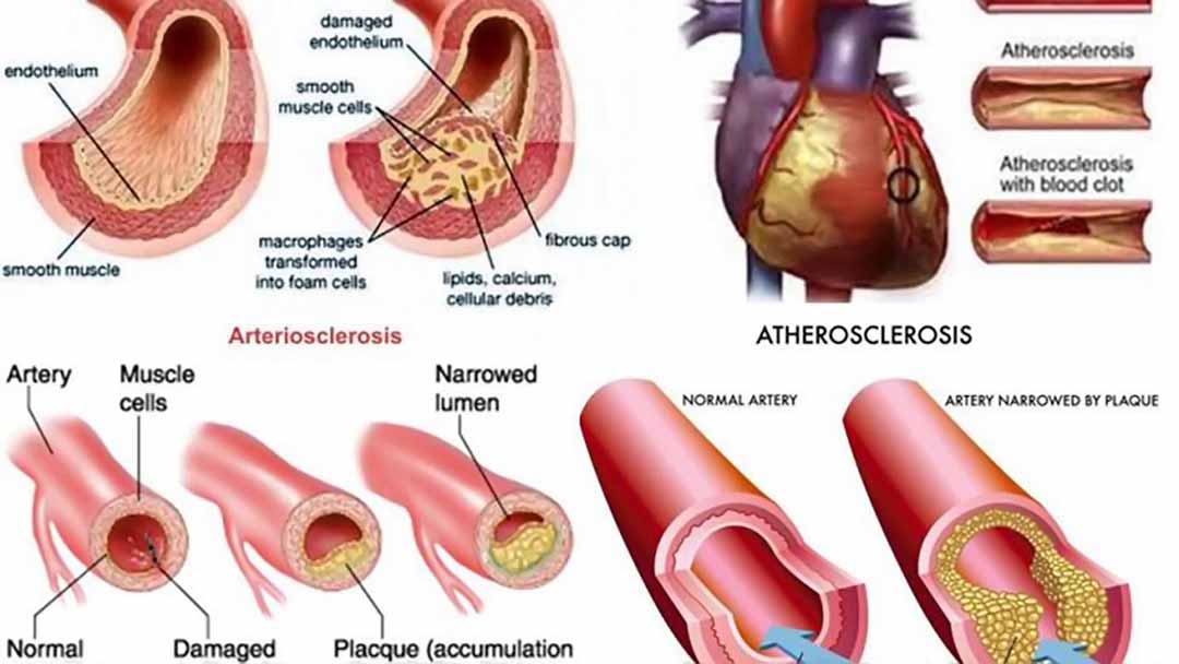 Bài thuốc chữa xơ vữa mạch máu hiệu quả