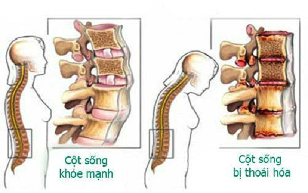 Bài thuốc dân gian chữa bệnh thoái hóa cột sống an toàn hiệu quả