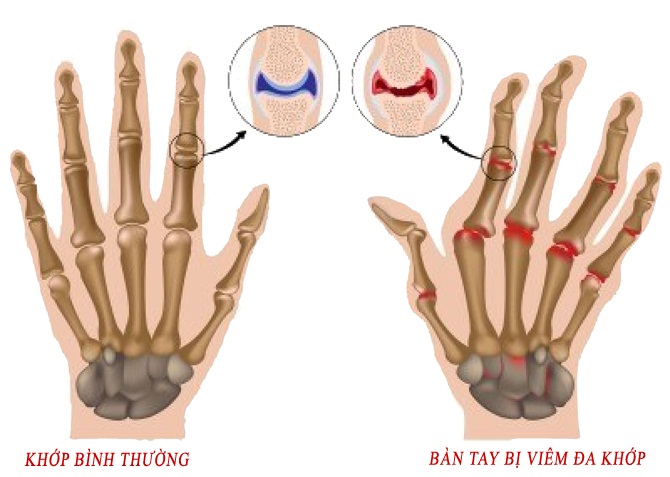 Bài thuốc dân gian chữa bệnh viêm đa khớp an toàn hiệu quả