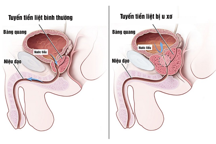 Bài thuốc dân gian chữa đi tiểu đêm nhiều lần