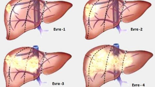Bài thuốc trị ung thư gan giai đoạn cuối trong đông y như thế nào
