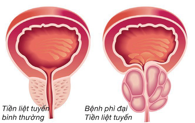 Bảng phân tích tuyến tiền liệt