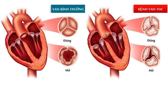 Bất thường van tim