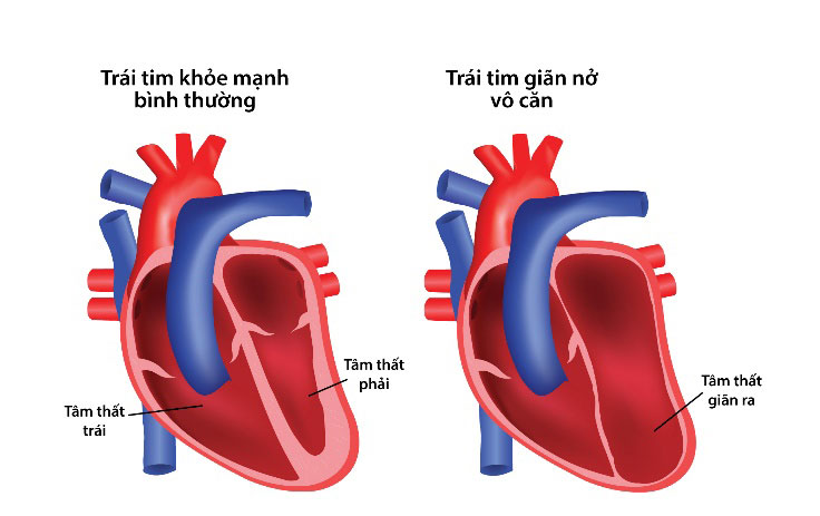 Bệnh cơ tim giãn có nguy hiểm không