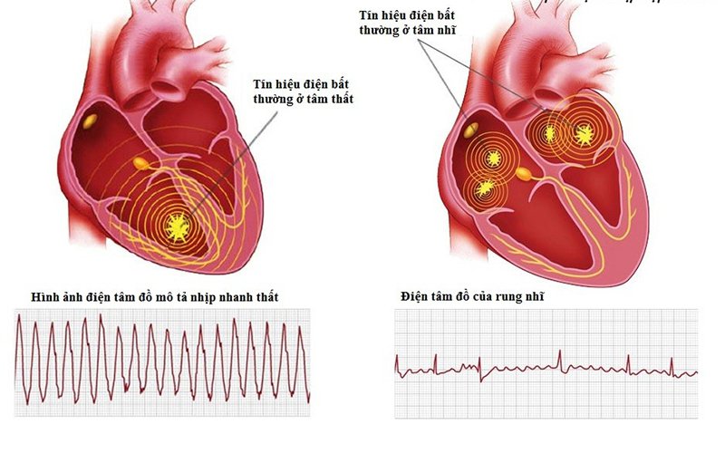 Bệnh cơ tim loạn nhịp thất phải