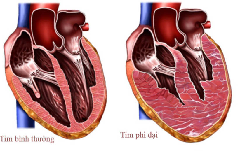 Bệnh cơ tim phì đại có nguy hiểm không