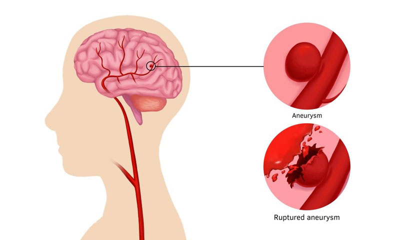 Bệnh dị dạng mạch máu não có nguy hiểm không và cách điều trị ra sao