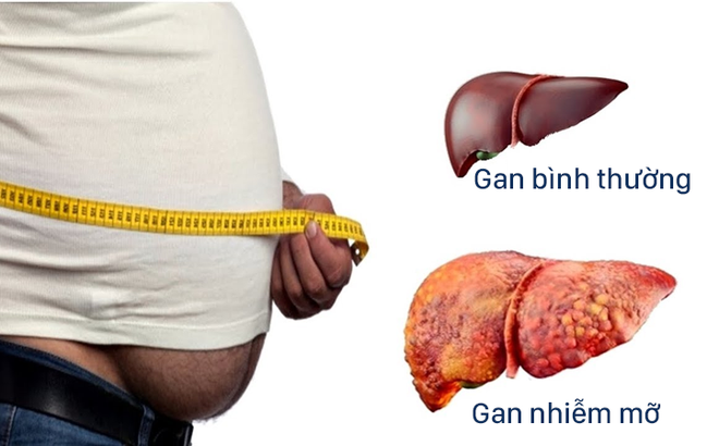 Bệnh gan có lây qua đường ăn uống không