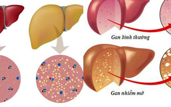 Bệnh gan nhiễm mỡ và cách điều trị an toàn hiệu quả