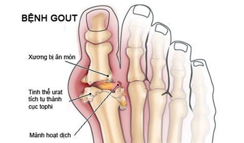 Đau nhức xương khớp, triệu chứng và các bệnh liên quan