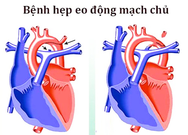 Hẹp eo động mạch chủ