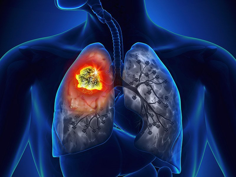 Bệnh nhân ung thư phổi không nên ăn gì tốt cho bệnh