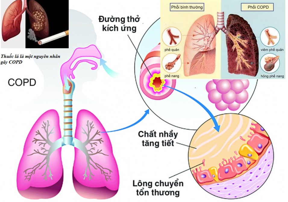Bệnh phổi mạn tính là gì và cách phòng bệnh ra sao