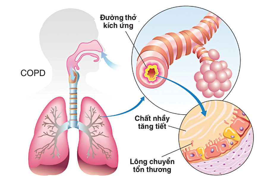 bệnh phổi tắc nghẽn mạn tính có chữa được không