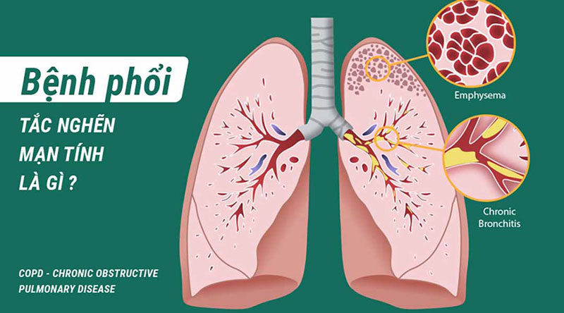 Bệnh phổi tắc nghẽn mạn tính có lây không 