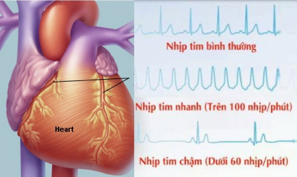 Bệnh rối loạn nhịp tim có nguy hiểm không và cách điều trị như thế nào