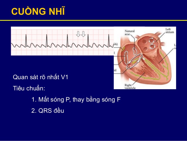 Bệnh rối loạn nhịp tim có nguy hiểm không và cách điều trị như thế nào