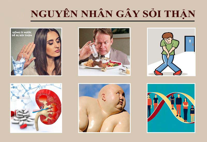 Bệnh sỏi thận gây ra bởi những nguyên nhân nào