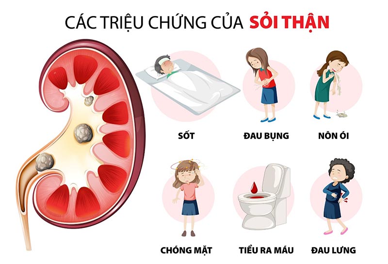 Bệnh sỏi thận ở người cao tuổi nguyên nhân và cách điều trị