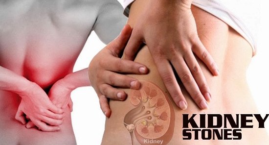 Bệnh sỏi thận và cách chữa an toàn hiệu quả