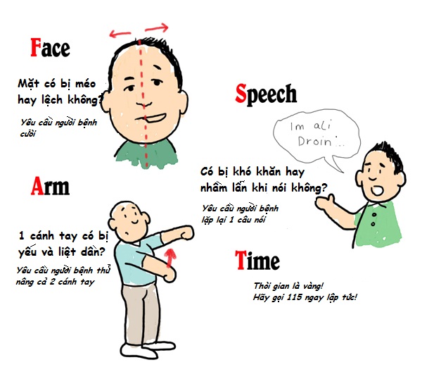 Bệnh tai biến mạch máu não là gì 