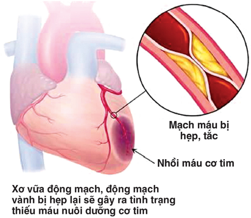 bệnh thiếu máu cơ tim nên ăn gì tốt nhất hiện nay