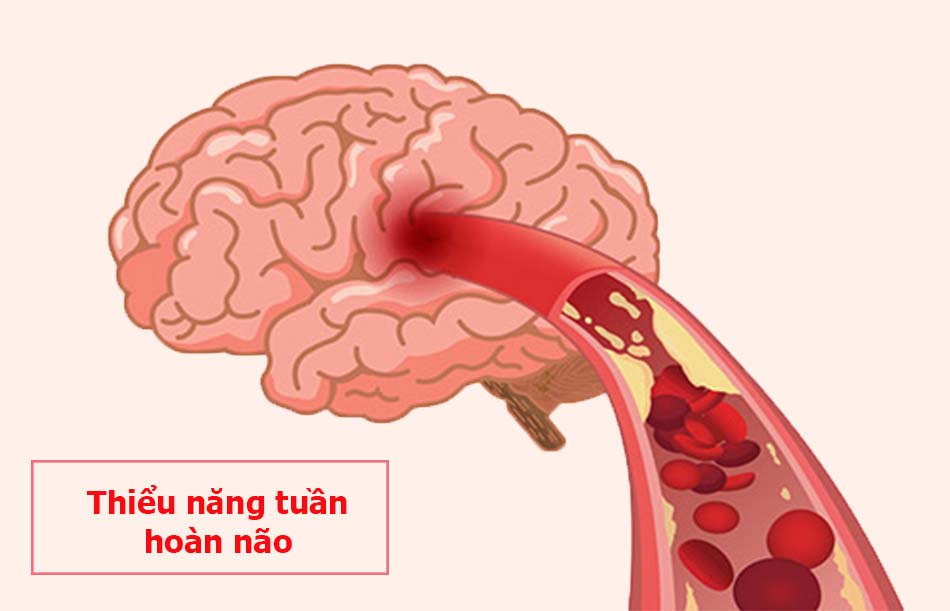 Bệnh thiểu năng tuần hoàn não và cách chữa hiệu quả