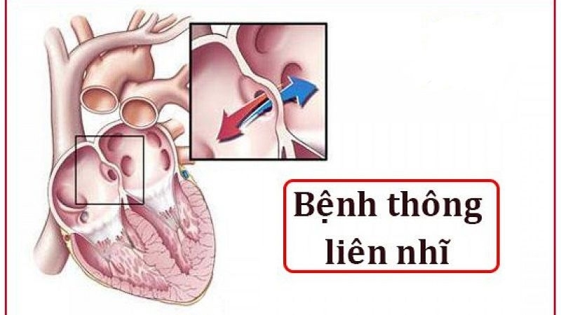 Thông liên nhĩ