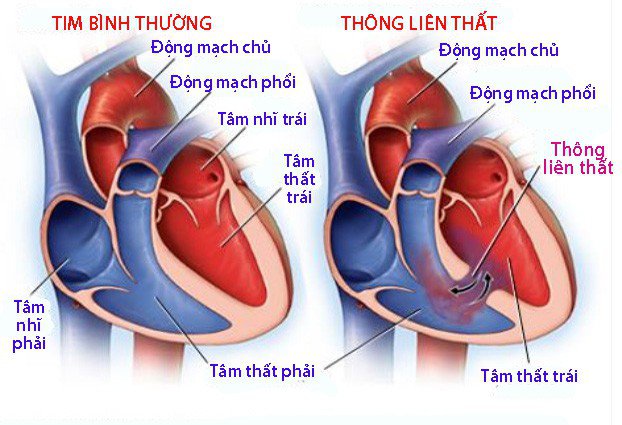 bệnh thông liên thất