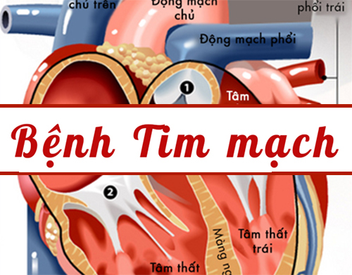 bệnh tim mạch