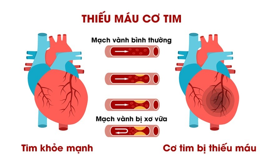 Bệnh tim thiếu máu cục bộ 