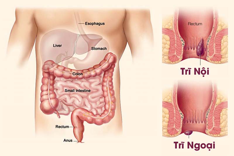 Bệnh trĩ đâu còn là nỗi lo - giải pháp từ thảo dược tự nhiên