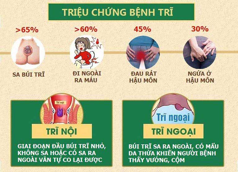 Bệnh trĩ đâu còn là nỗi lo