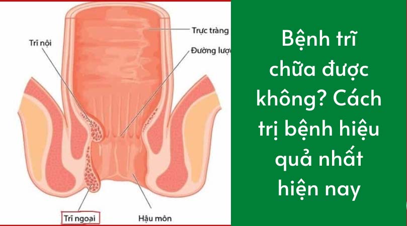 Bệnh trĩ nếu không chữa có sao không