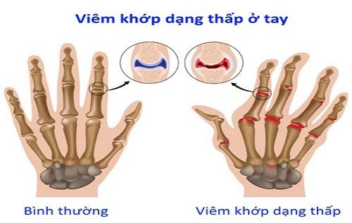 Bệnh viêm đa khớp dạng thấp nên ăn gì tốt nhất hiện nay