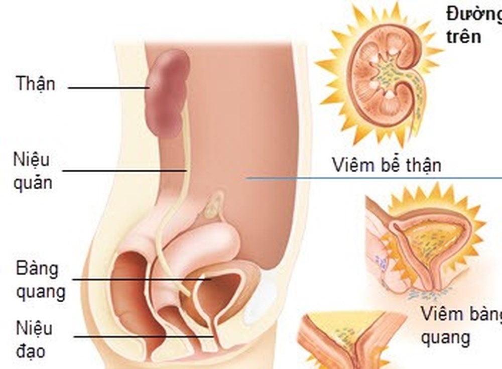 Bệnh viêm đường tiết niệu ở phụ nữ và cách khắc phục