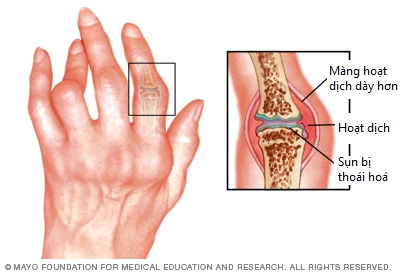 viêm khớp dạng thấp