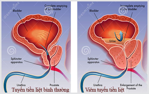 Bệnh viêm tuyến tiền liệt ở nam giới là gì