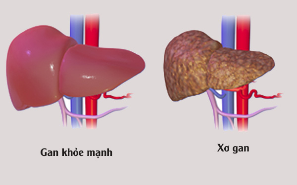 gan khỏe mạnh và xơ gan