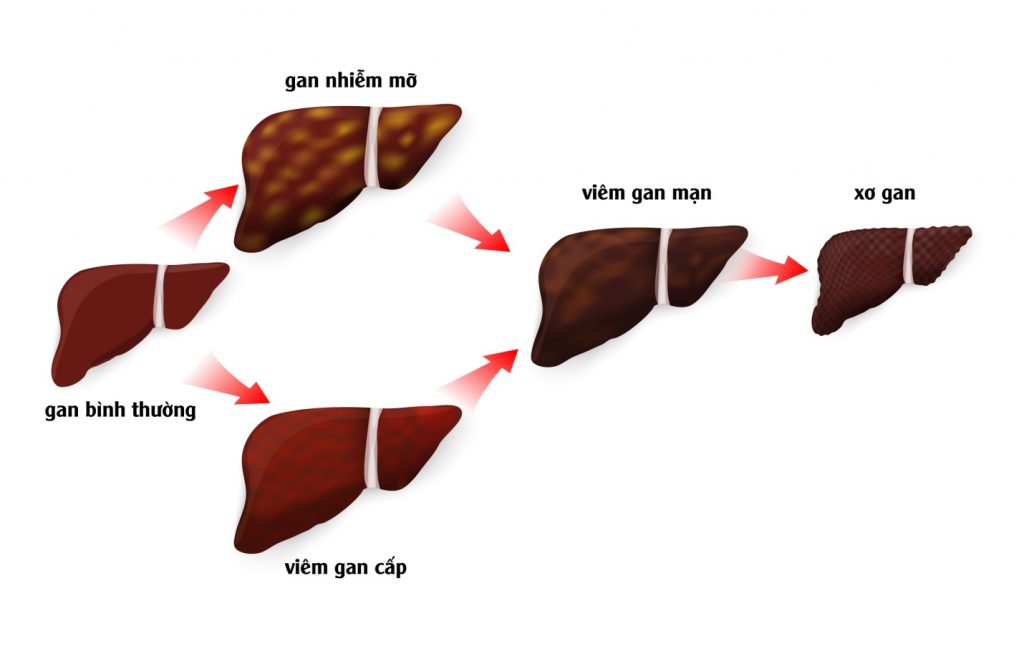 Bệnh xơ gan có lây không và cách phòng trị bệnh